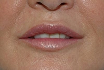 Lip Augmentation Before & After Gallery - Patient 398257 - Image 2
