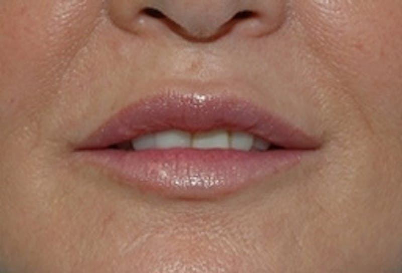 Lip Augmentation Before & After Gallery - Patient 398257 - Image 2