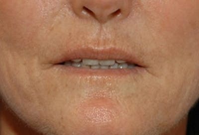 Lip Augmentation Before & After Gallery - Patient 348888 - Image 1