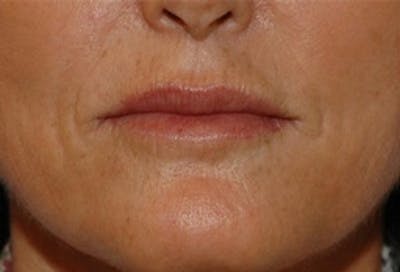 Lip Augmentation Before & After Gallery - Patient 348888 - Image 2