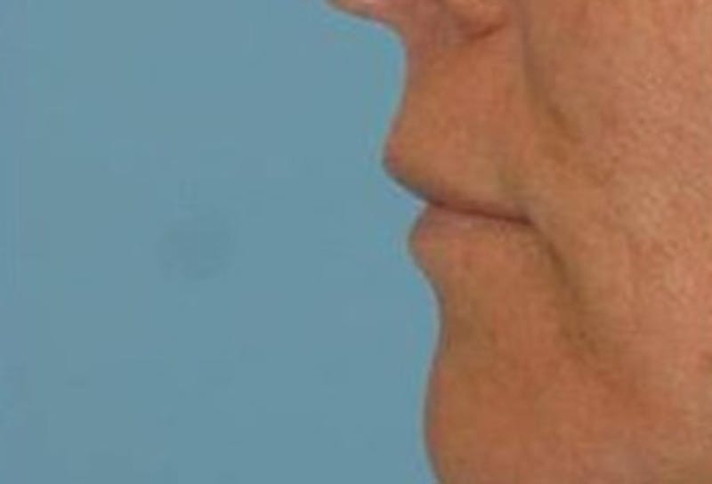 Lip Augmentation Before & After Gallery - Patient 348888 - Image 3