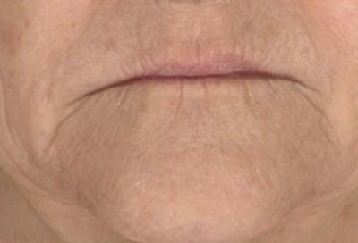 Lip Augmentation Before & After Gallery - Patient 361822 - Image 1