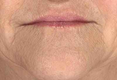 Lip Augmentation Before & After Gallery - Patient 361822 - Image 2