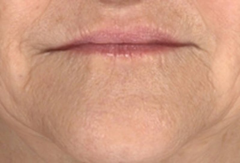 Lip Augmentation Before & After Gallery - Patient 361822 - Image 2