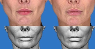  Wrinkles, Folds, and Hollows Before & After Gallery - Patient 372240 - Image 1