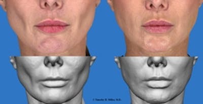  Wrinkles, Folds, and Hollows Before & After Gallery - Patient 372240 - Image 2