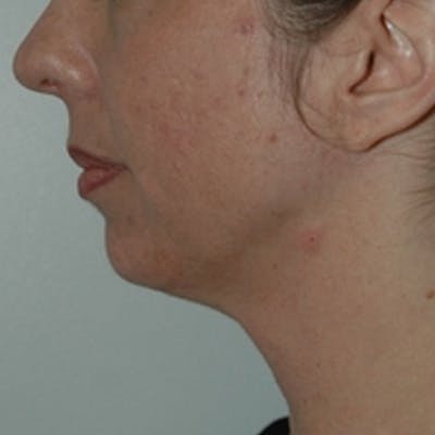 Wrinkles, Folds, and Hollows Before & After Gallery - Patient 251869 - Image 1