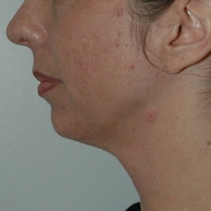  Wrinkles, Folds, and Hollows Before & After Gallery - Patient 251869 - Image 1