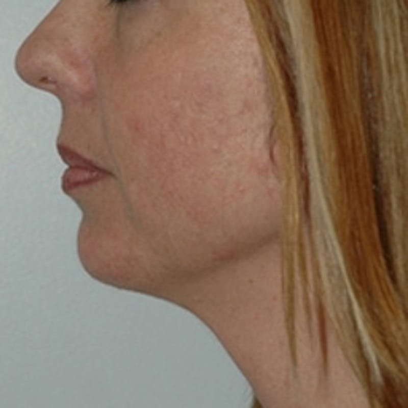  Wrinkles, Folds, and Hollows Before & After Gallery - Patient 251869 - Image 2