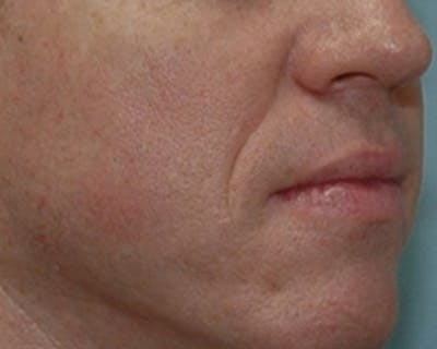 Wrinkles, Folds, and Hollows Before & After Gallery - Patient 323605 - Image 1