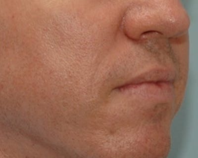  Wrinkles, Folds, and Hollows Before & After Gallery - Patient 323605 - Image 2