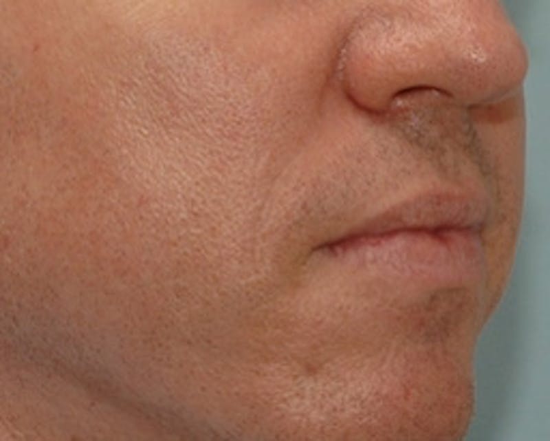  Wrinkles, Folds, and Hollows Before & After Gallery - Patient 323605 - Image 2