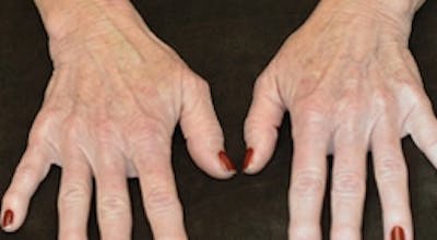 Hand Rejuvenation Before & After Gallery - Patient 236670 - Image 1