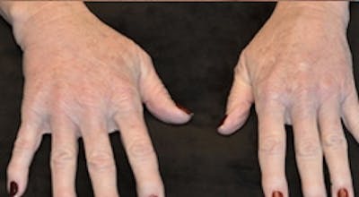 Hand Rejuvenation Before & After Gallery - Patient 236670 - Image 2