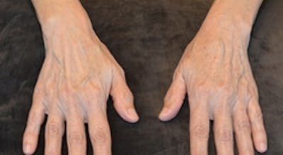 Hand Rejuvenation Before & After Gallery - Patient 401893 - Image 1