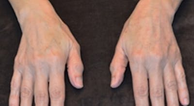 Hand Rejuvenation Before & After Gallery - Patient 401893 - Image 2