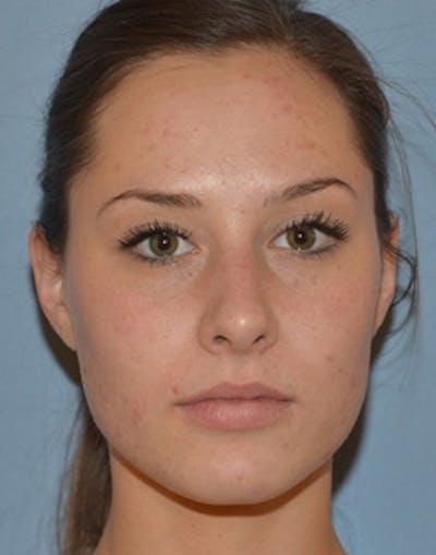 Hydrafacial Before & After Gallery - Patient 117119 - Image 2