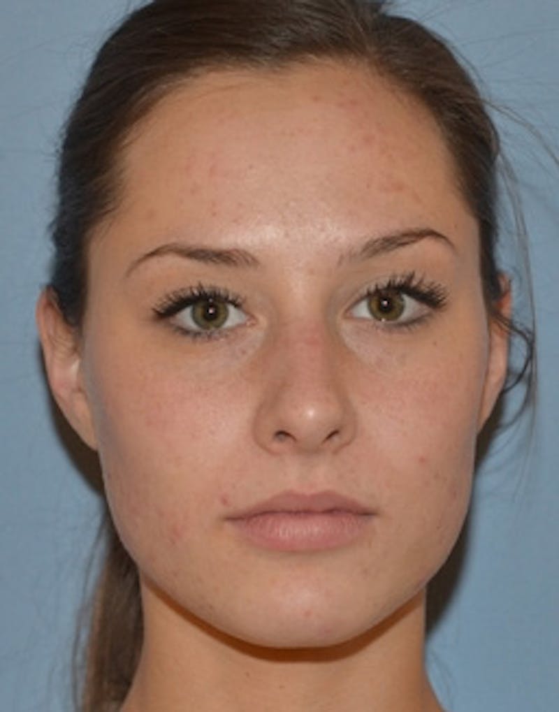 Hydrafacial Before & After Gallery - Patient 117119 - Image 2
