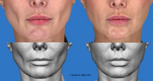 voluma example