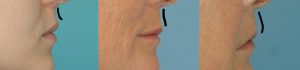 female's lip filler results
