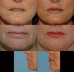 females lip filler results
