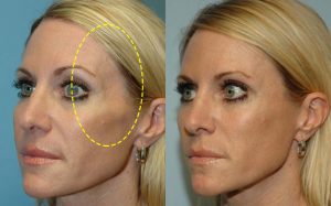 temple filler patient