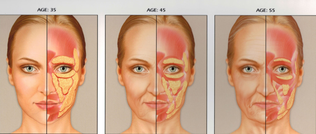 sculptra patient infographic