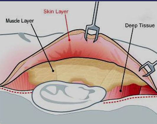 muscle layer
