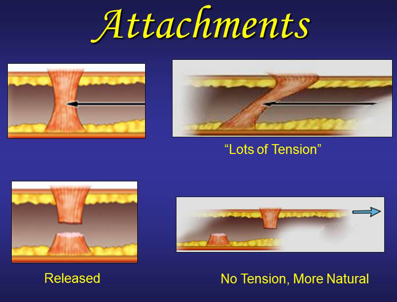 attachements