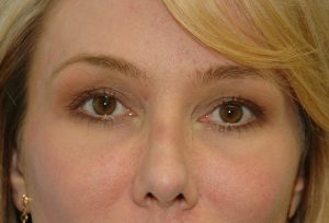 3 month result: fat augmentation, laser, skin care products
