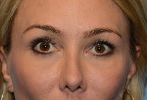5 year result (fat augmentation, laser, skin care products