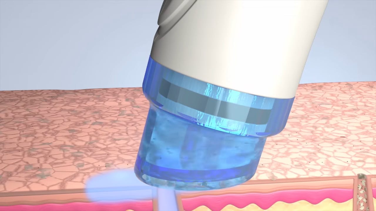 animation of hydrafacial