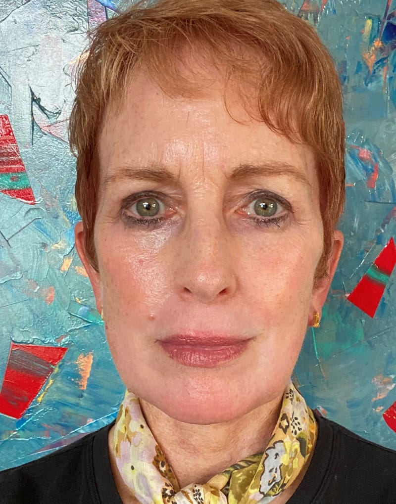 facelift patient
