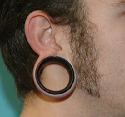 Ear Surgery Before & After Gallery - Patient 342213 - Image 1