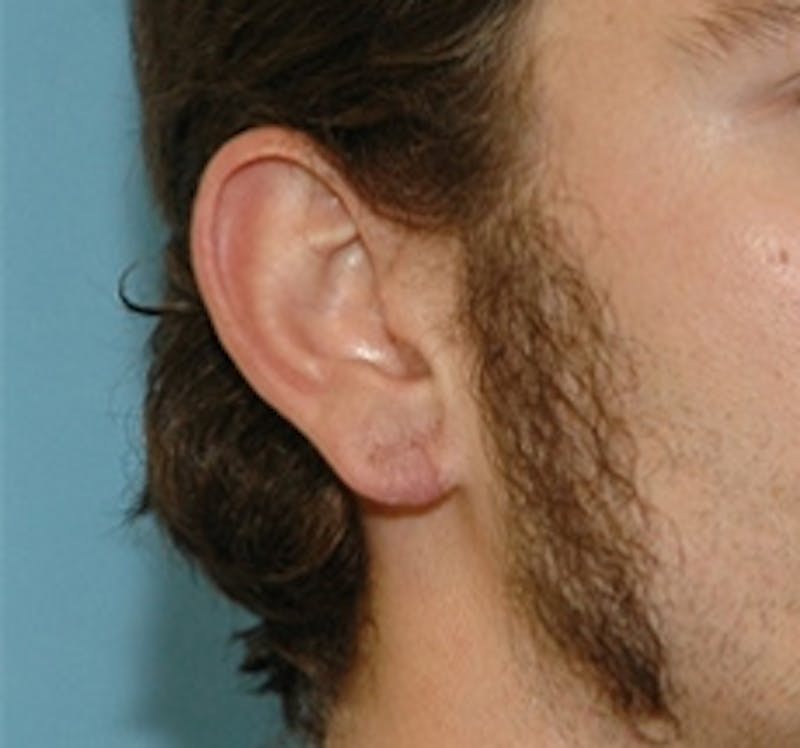 Ear Surgery Before & After Gallery - Patient 342213 - Image 2