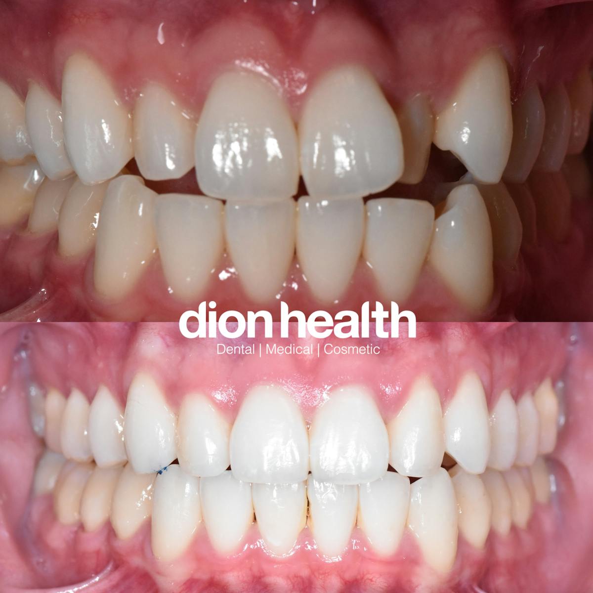 Smile Makeover Before & After Gallery - Patient 315790 - Image 1