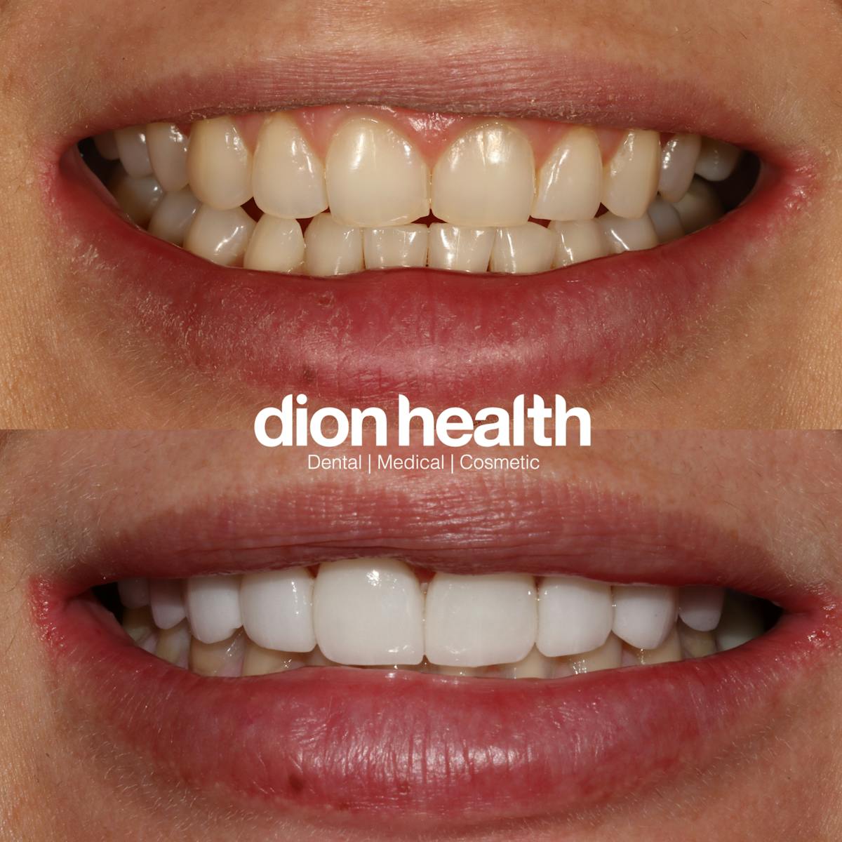 Smile Makeover Before & After Gallery - Patient 116133 - Image 1