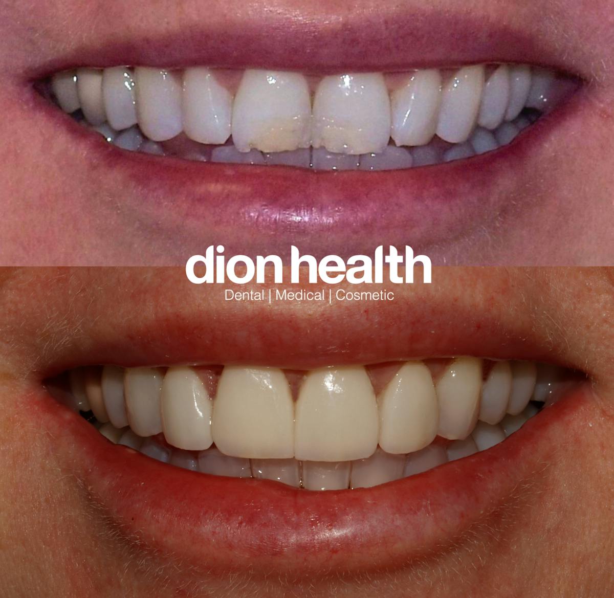 Smile Makeover Before & After Gallery - Patient 329516 - Image 1