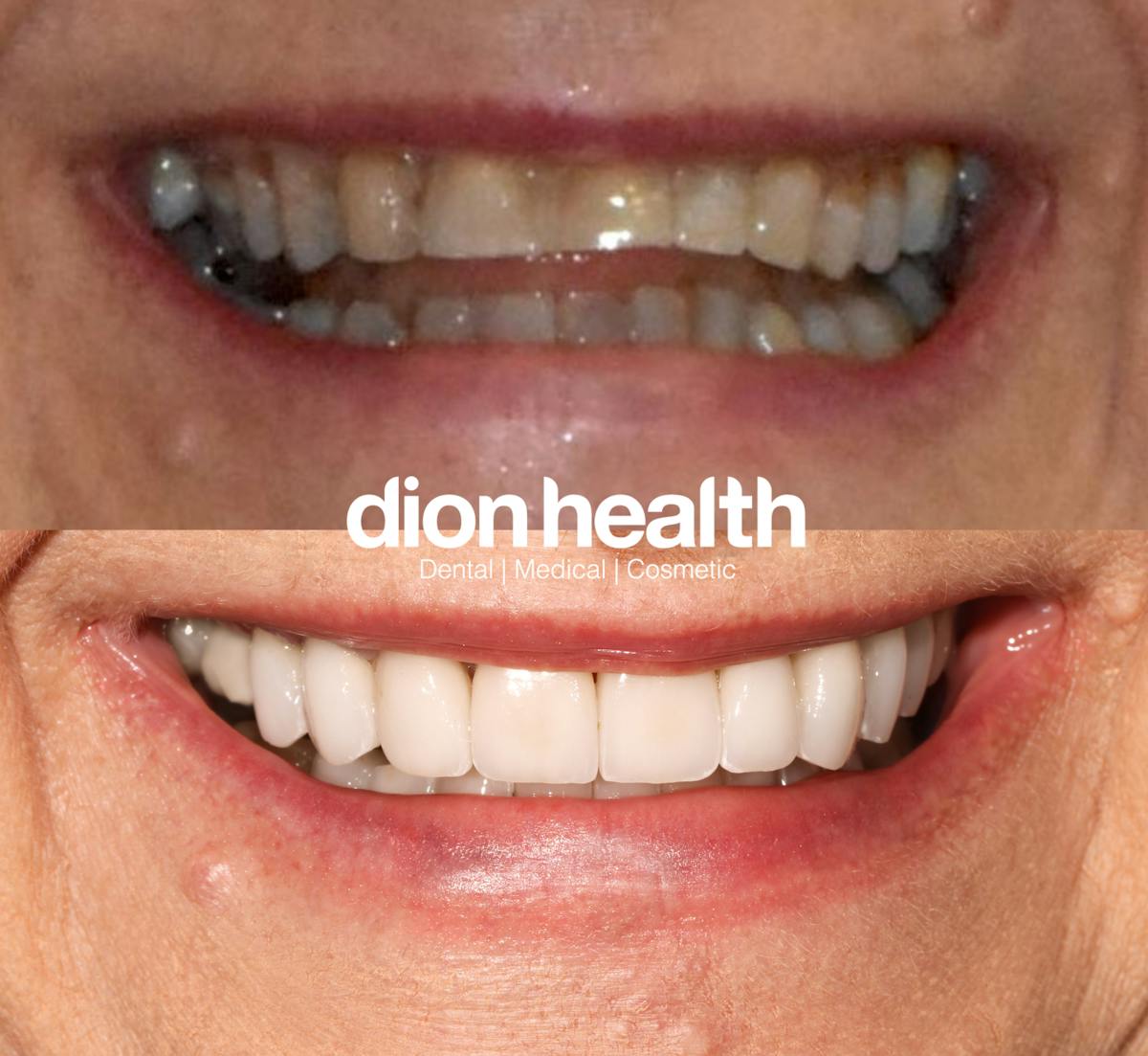 Smile Makeover Before & After Gallery - Patient 192513 - Image 1