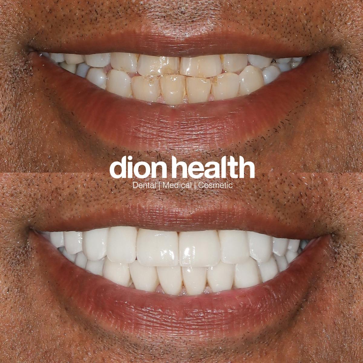 Smile Makeover Before & After Gallery - Patient 186902 - Image 1