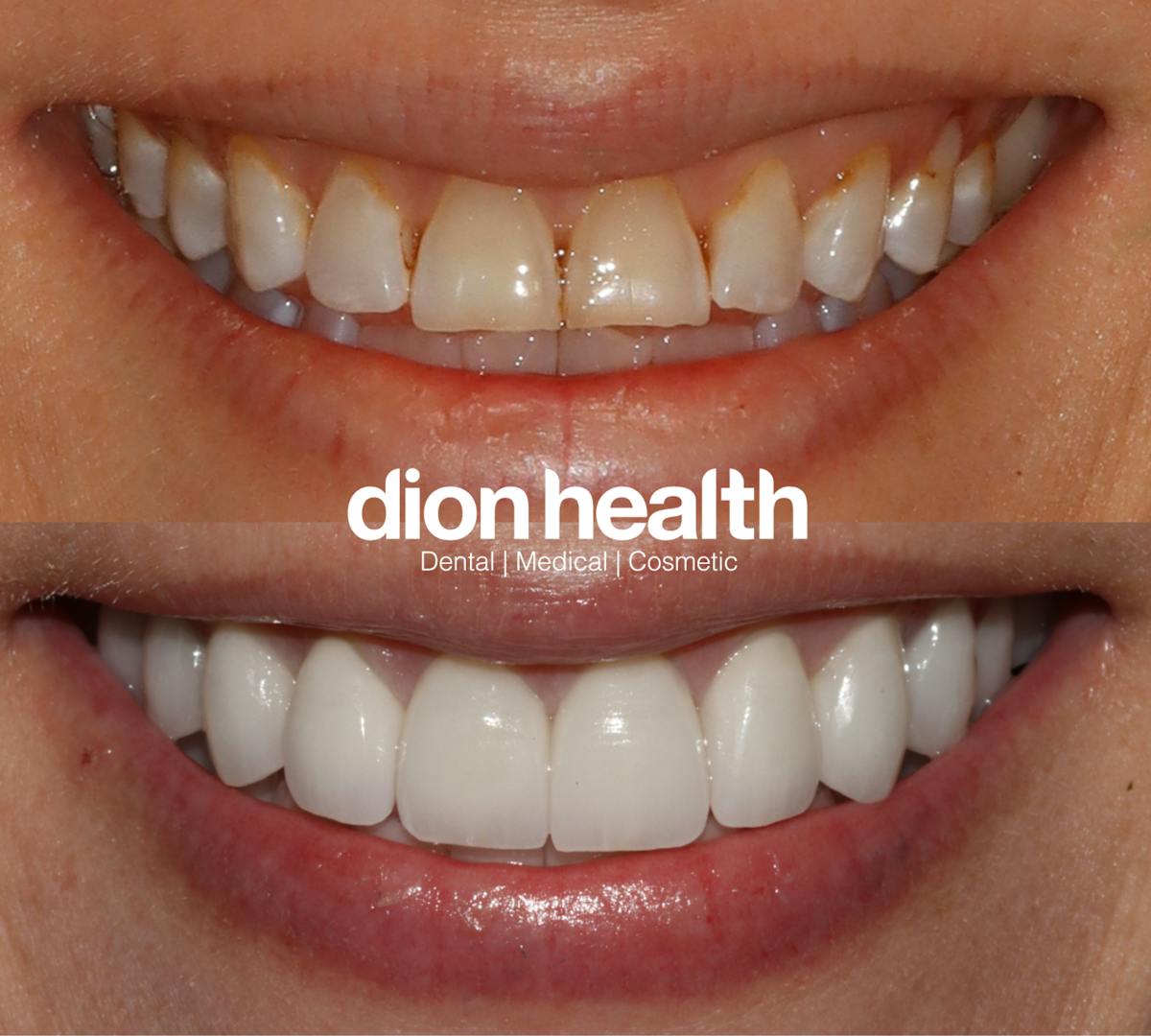 Smile Makeover Before & After Gallery - Patient 345056 - Image 1