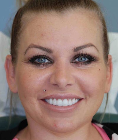 Anti Aging Before & After Gallery - Patient 343792 - Image 2
