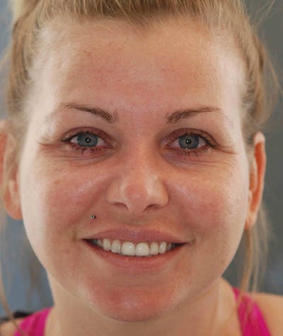 Anti Aging Before & After Gallery - Patient 343792 - Image 1