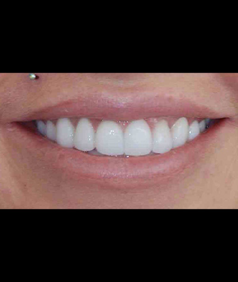 Anti Aging Before & After Gallery - Patient 343792 - Image 4