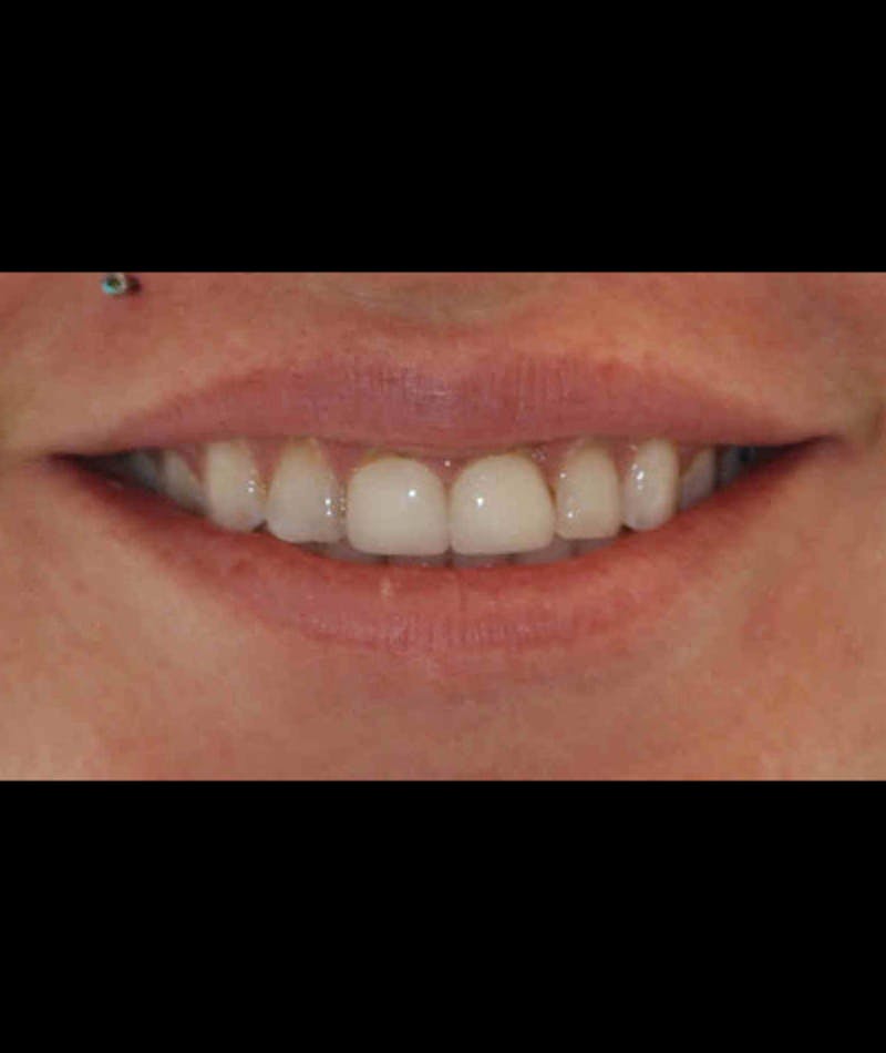 Anti Aging Before & After Gallery - Patient 343792 - Image 3