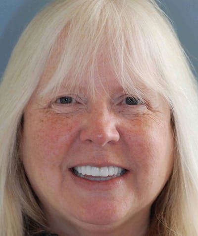 Anti Aging Before & After Gallery - Patient 352066 - Image 2