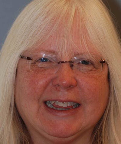 Anti Aging Before & After Gallery - Patient 352066 - Image 1