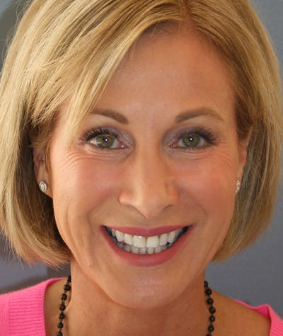 Anti Aging Before & After Gallery - Patient 409489 - Image 1