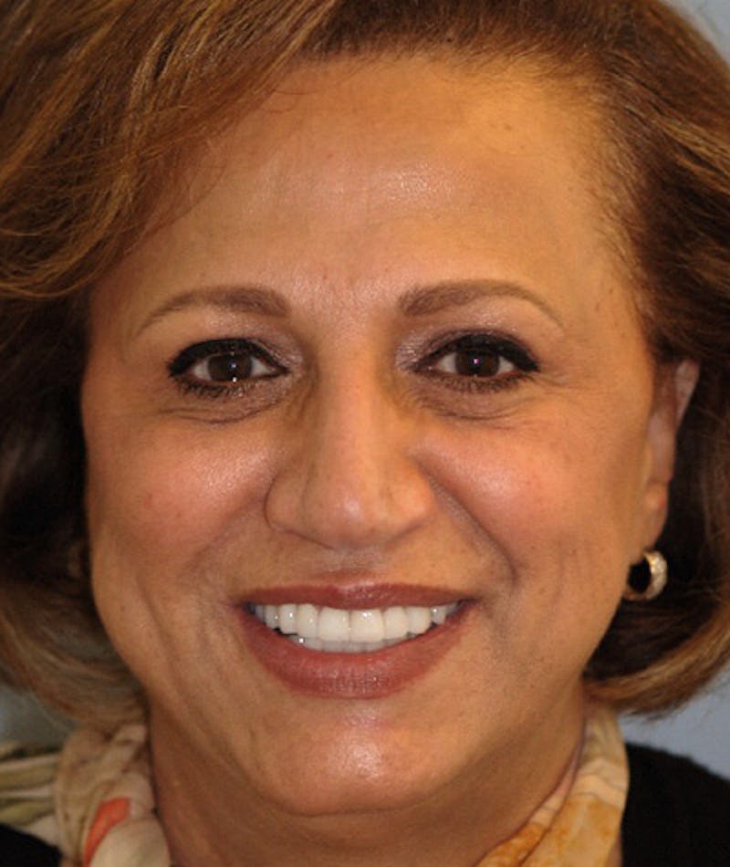 Anti Aging Before & After Gallery - Patient 347666 - Image 2