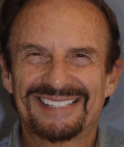 Anti Aging Before & After Gallery - Patient 237149 - Image 2